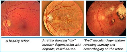 Stem cell op could bring back sight for millions: AMD Breakthrough
