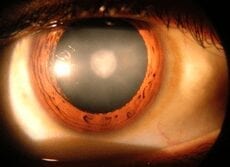 Eye Drops Could Clear Up Cataracts Using Newly Identified Chemical