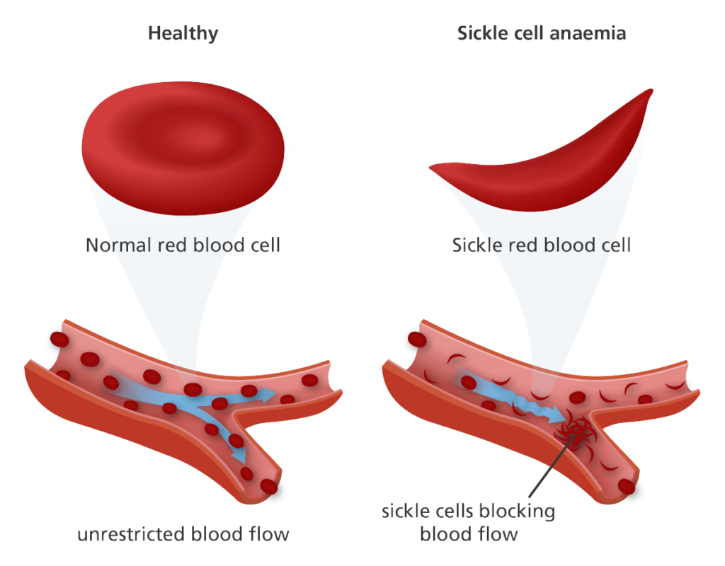 Multiple Myeloma Drug Could Revolutionize Treatment For Sickle Cell 