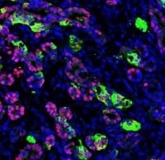 Human Skin Cells Used to Create Insulin-Producing Pancreatic Cells