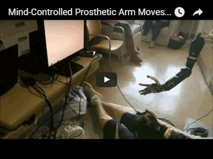 Mind-Controlled Prosthetic Arm Moves Individual ‘Fingers’
