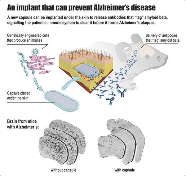 An implant to prevent Alzheimer's