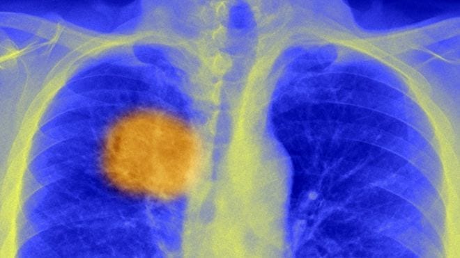 Breakthrough in cancer research could spawn new treatments
