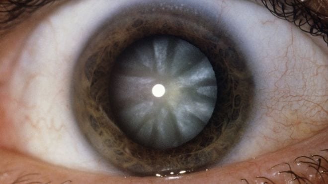 'Stunning' operation regenerates eye's lens