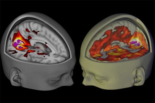 Brain scans reveal how LSD affects consciousness
