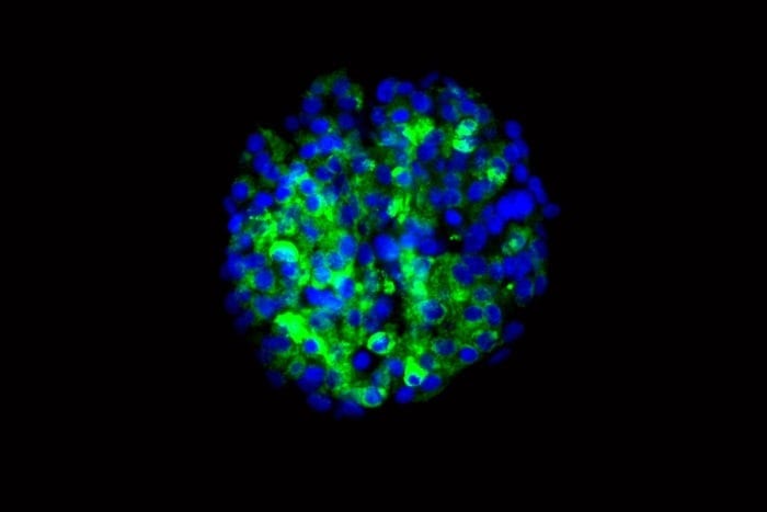 Stem cells from diabetic patients coaxed to become insulin-secreting cells