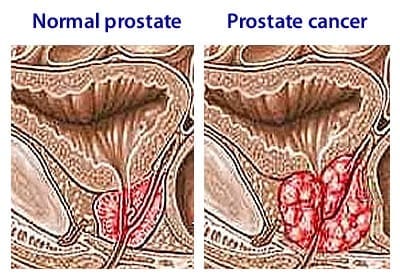 Consumption of a bioactive compound from Neem plant could significantly suppress development of prostate cancer