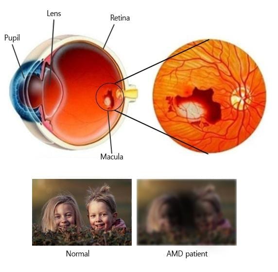 CRISPR-Cas9 can be delivered directly into the eye of living animals to treat age-related macular degeneration efficiently and safely