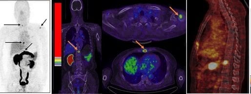 First-in-human application of a new imaging agent to help find prostate cancer in both early and advanced stages