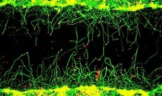 A natural molecule can repair axons damaged in spinal cord injuries and strokes