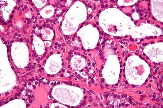 Synthetic biomarkers could be used to diagnose ovarian cancer months earlier than now possible