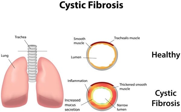 Single treatment option for cystic fibrosis patients corrects genetic and tissue defects and significantly reduces inflammation