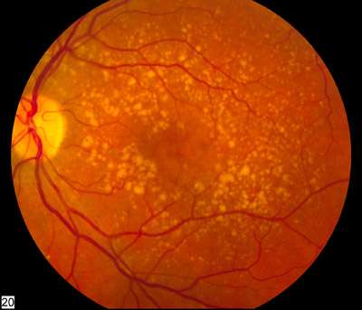Preserving the vision of people with wet age-related macular degeneration (AMD) with a new and safe gene therapy