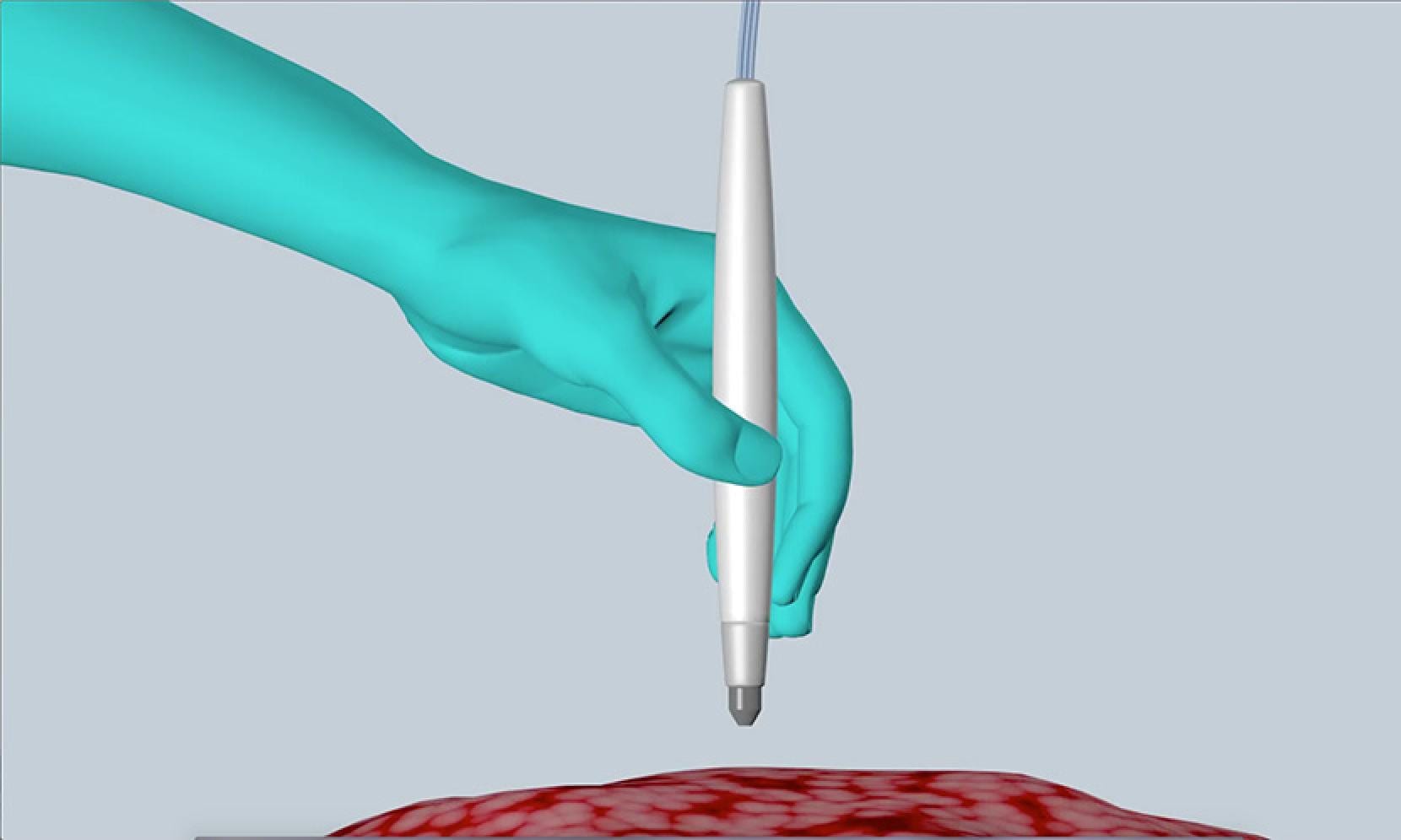 A powerful tool that rapidly and accurately identifies cancerous tissue during surgery in about 10 seconds