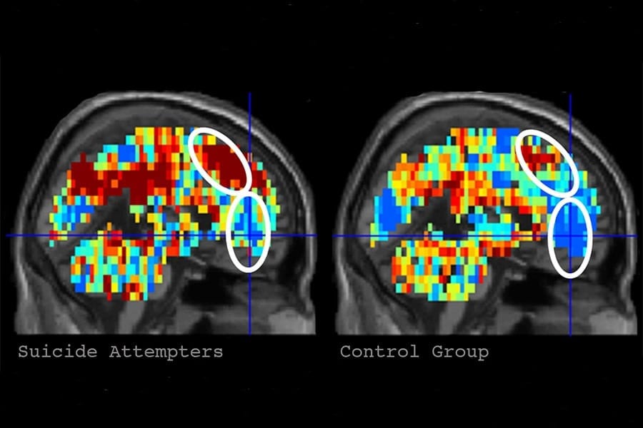 Brain imaging can identify individuals with suicidal thoughts