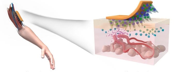 Dissolvable microneedle skin patch for type 2 diabetes