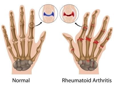 Game changing precision medicine comes to rheumatoid arthritis