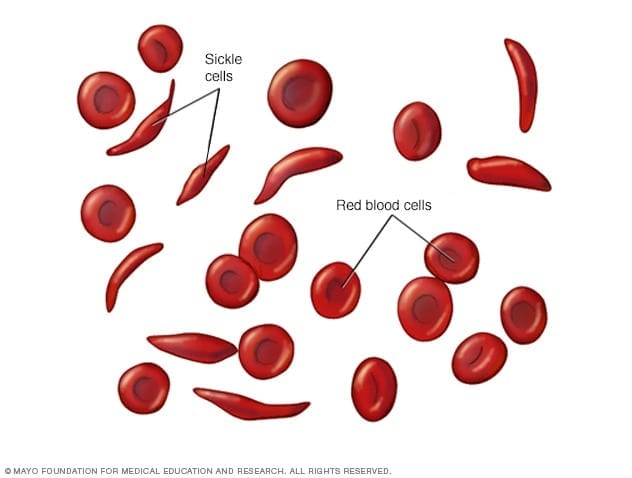 A sickle cell cure gets closer