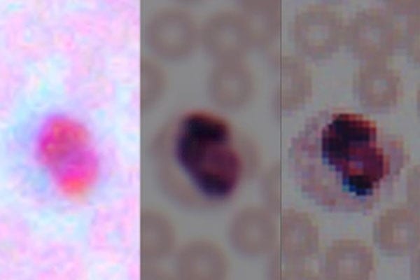 Artificial intelligence, can discern and enhance microscopic details in photos taken by smartphones to approach the quality of images from laboratory-grade microscopes