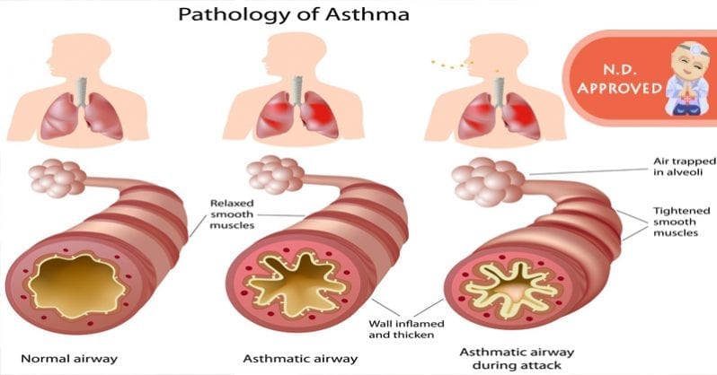 Defeating asthma attacks by going small