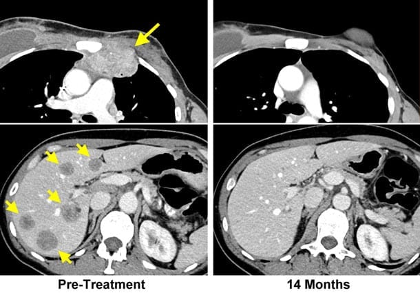 New approach to immunotherapy has led to the complete regression of breast cancer in a patient who was unresponsive to all other treatments