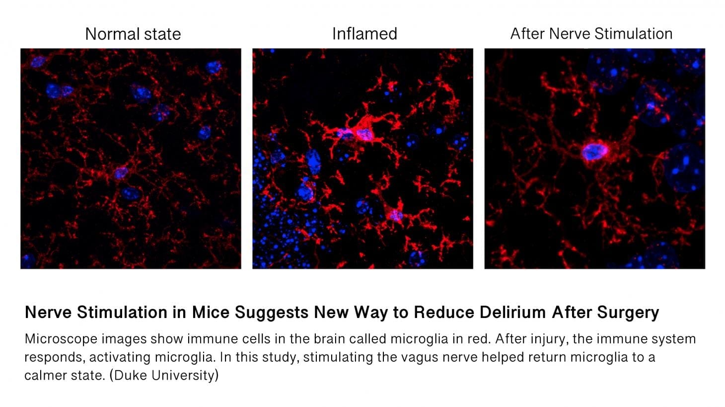A new way to reduce delirium after surgery