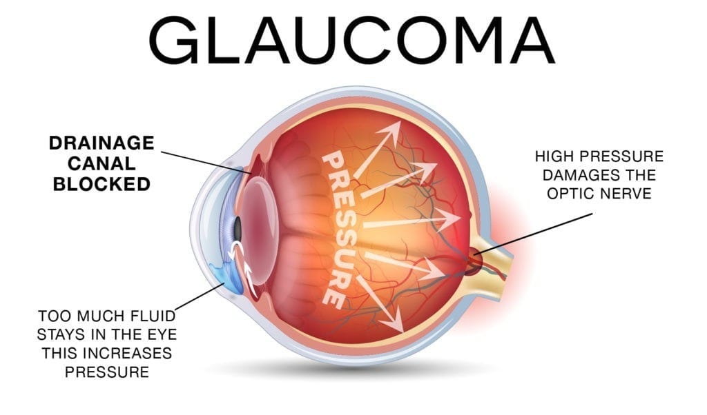 Facilitating the early detection of glaucoma