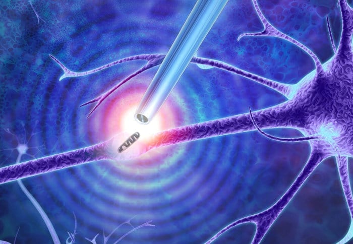 A tiny device that could one day offer an alternative to open brain surgery
