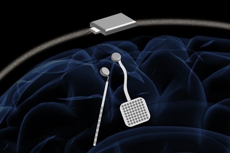 A new neurostimulator works like a pacemaker for the brain monitoring the brain’s electrical activity and delivering electrical stimulation