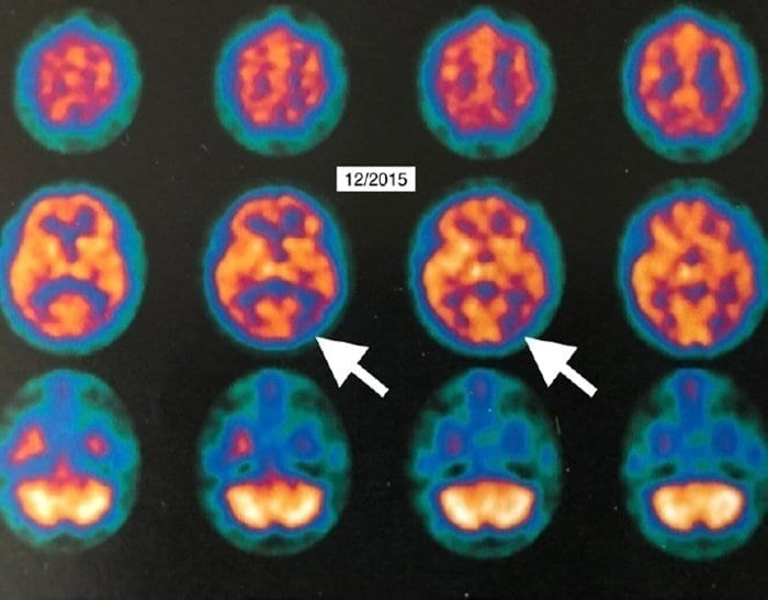 First evidence of improvement in brain metabolism in Alzheimer’s disease in a patient treated with hyperbaric oxygen therapy