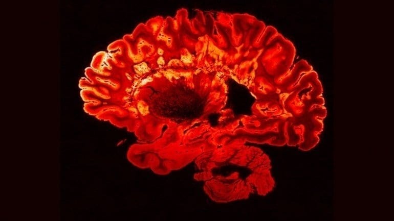 Gut immune cells can reduce brain inflammation in people with multiple sclerosis