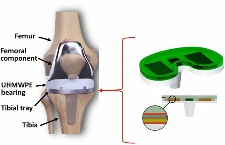Smart knee implants can provide doctors with regular activity updates and are powered by the patient’s movement