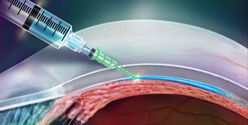 Researchers invent a resistance-sensing injection device (needle) that knows where to go