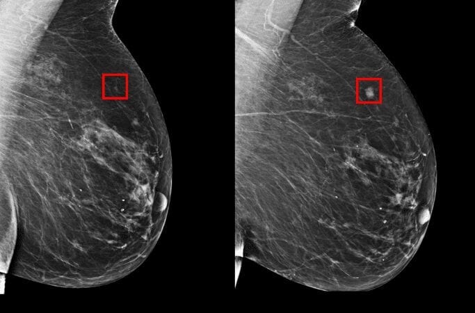 New AI deep learning model can detect future breast cancer risk better than current models