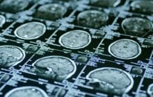 Could risk for psychotic disorders be detected by neurological brain markers