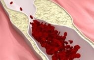 A promising therapeutic approach to halt and potentially reverse plaque buildup in arteries