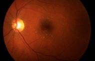 Gene therapy is showing promise for wet age-related macular degeneration