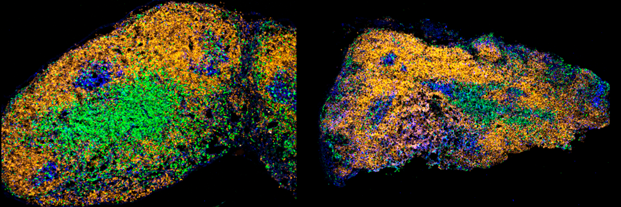 A comparison of mouse lymph nodes from young (left) and aged (right) mice fourteen days after immunisation. B cell follicles are shown in yellow (IgD) and proliferating germinal centre cells (Blue, Ki67) are shown within the B cell follicle. T cells are shown in green.