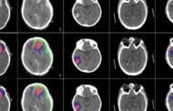 AI algorithm can detect and identify different types of brain injuries