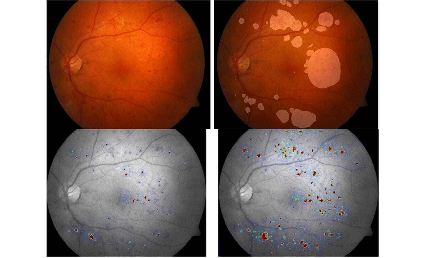 This series shows the four different stages of the same eye scan described in this article. From left to right: the original image; with highlights of anomalies by human experts; with highlights of anomalies by one scan by an AI system; with highlights of anomalies made by an iterative series of scans by an AI system. Note that the iterative process yields a more complete overview of the anomalies present than the single assessment.