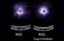 New eye drops could prevent vision loss after retinal vein occlusion: a major cause of blindness for millions