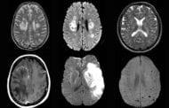 Strokes, delirium and other brain complications are reported from Covid-19 infections