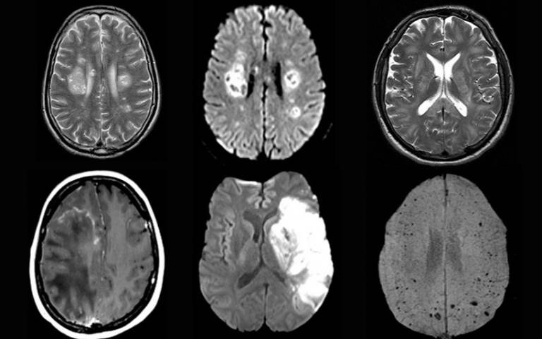 COVID-19 brain complications found across the globe - via UCL