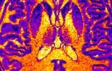 Can a brain scan and computer algorithm help to diagnose mental health conditions?