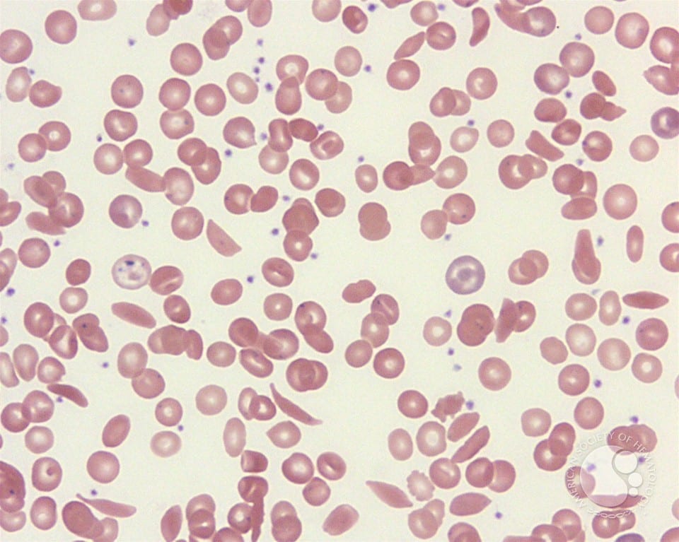 via Ash Image Bank

This blood smear shows sickle cell disease.