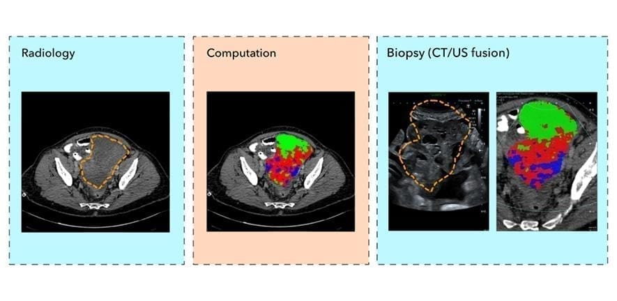 Could virtual biopsies replace tissue biopsies in the future?
