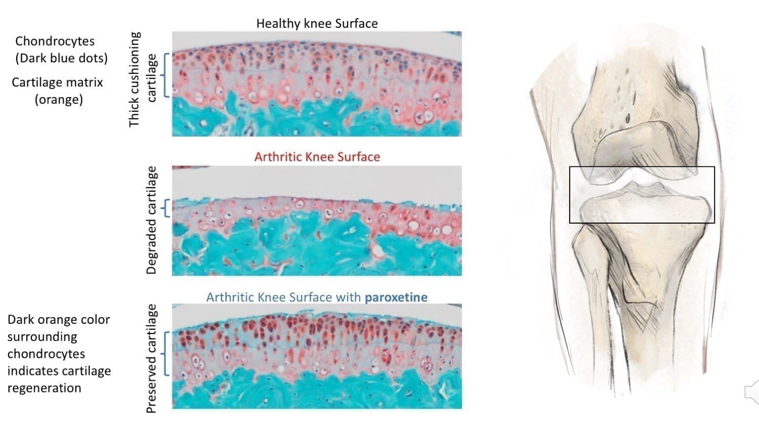 The first-ever treatment for osteoarthritis?