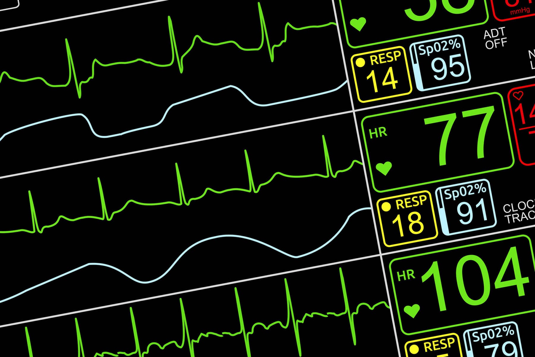 Patient's vital signs on ICU monitor, isolated closeup, dutched left
via UVA