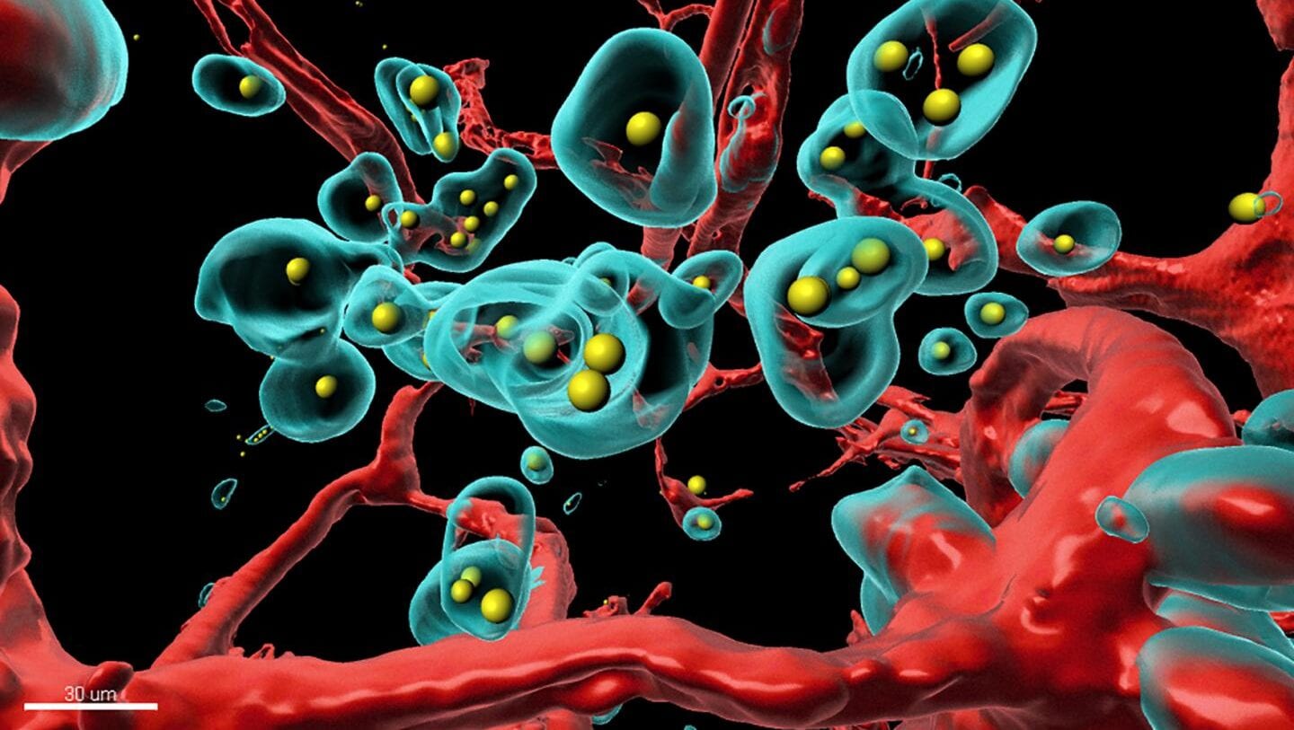 A piece of the tumor was made completely transparent and scanned in 3D with a special microscope. The components labeled with fluorescent colors were rendered in a rotatable 3D representation on the computer (red: blood vessels, turquoise: tumor cells, yellow: therapeutic antibody).

CREDIT
Plückthun Lab