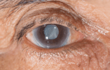 Drug therapy as an alternative to surgery for cataracts?